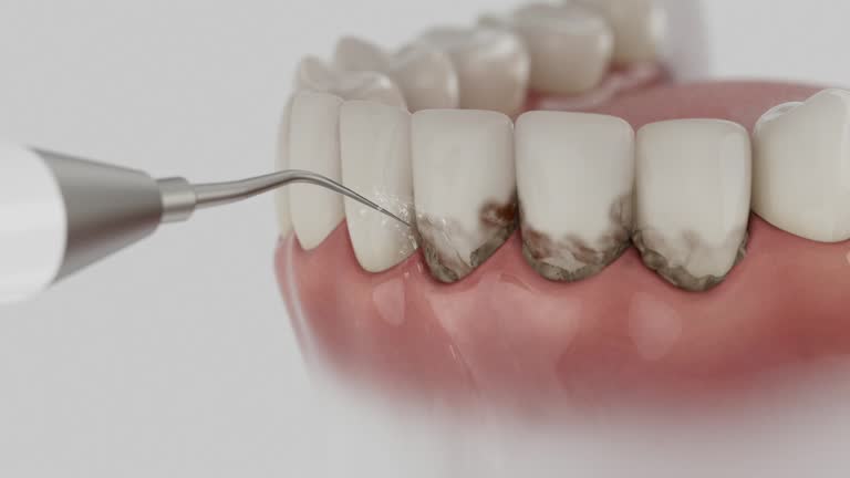 Trusted Invisalign Clear Aligners service in Johnstown, OH - Dentist Open Now